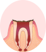 〈C4〉歯根のむし歯